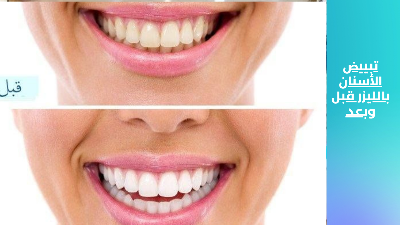 تبييض الأسنان بالليزر قبل وبعد من منصة تدريبكم