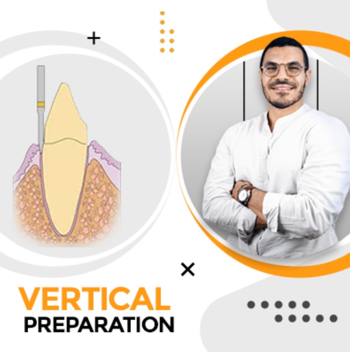 Vertical Prepartion